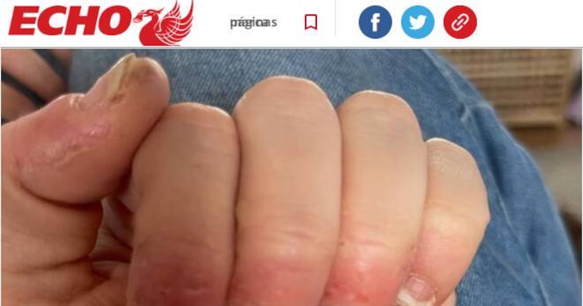 remédio para alergia a unha de gel