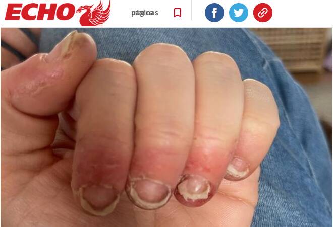 unha fraca e quebradiça após esmalte