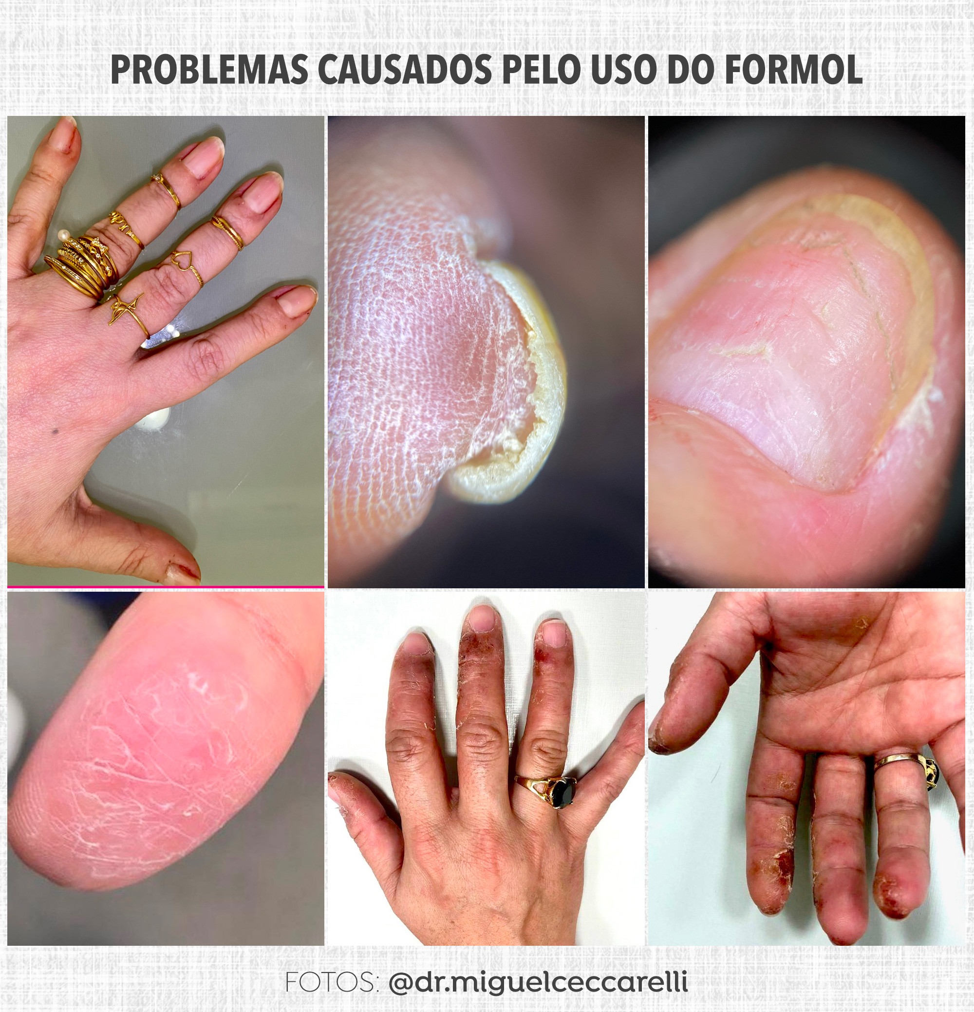 dermatologista para alergia de unha