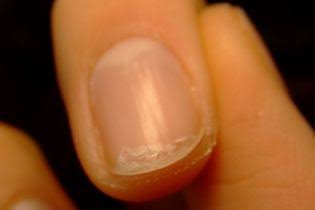 alergia a unha de gel
