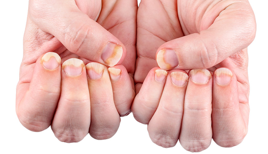 dermatite de contato nas unhas
