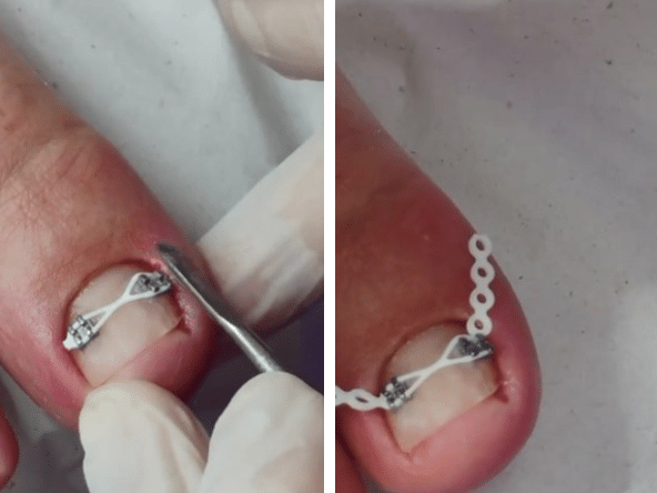 aparelho para unha encravada