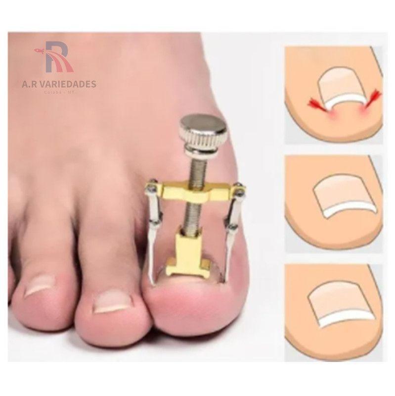 melhores aparelhos para unha encravada