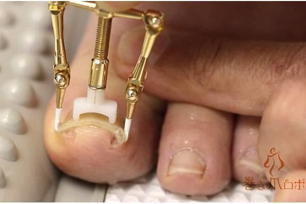 erros comuns ao usar aparelho para unha encravada