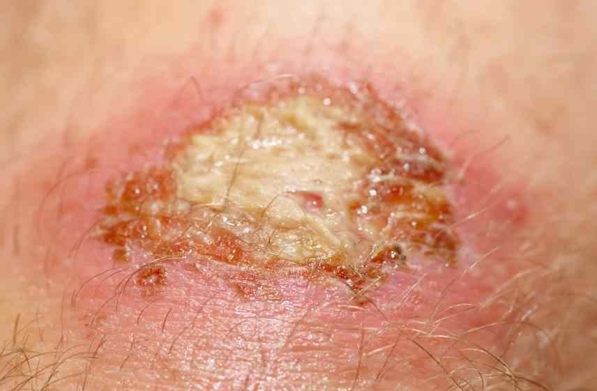 infecção de arranhão nas costas