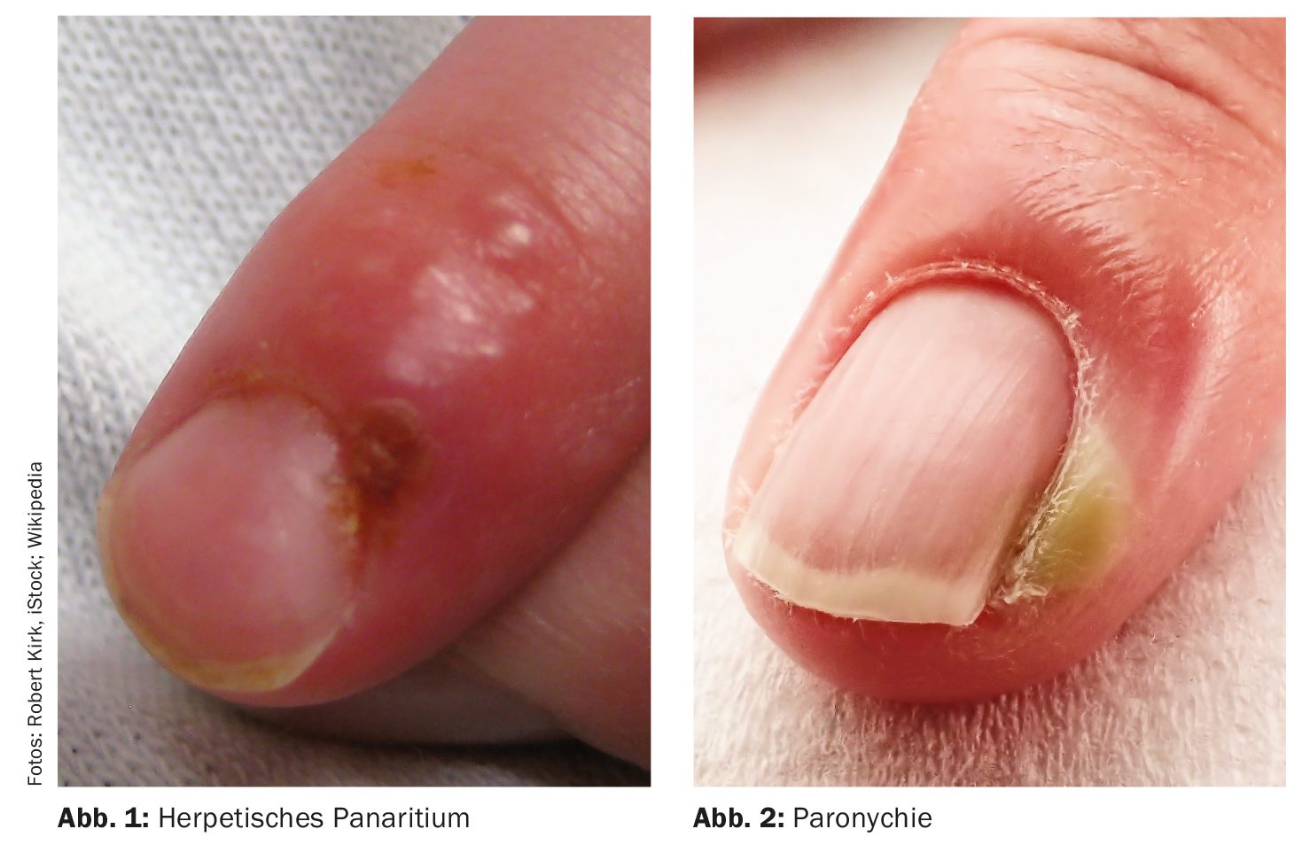 erros comuns ao tratar infecção bacteriana na unha