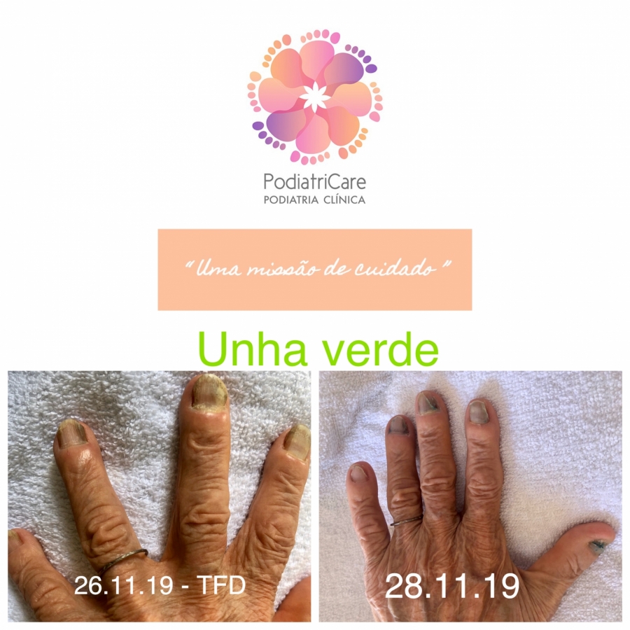 Paroníquia: Causas, Sintomas e Cuidados Essenciais