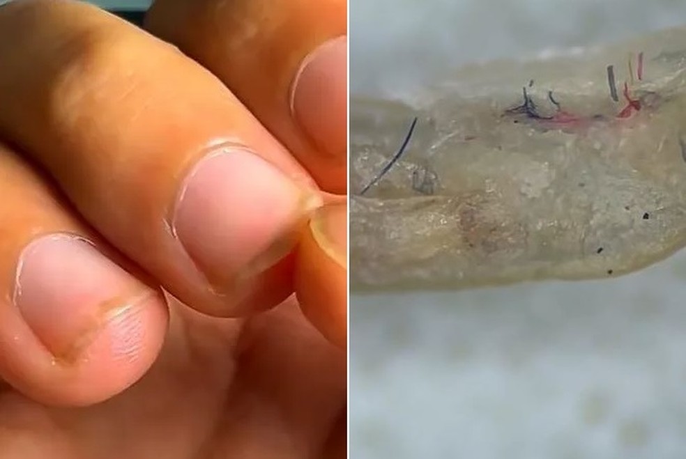 Paroníquia: Causas, Sintomas e Cuidados Essenciais