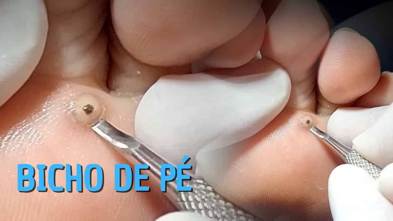 como tirar bicho da unha