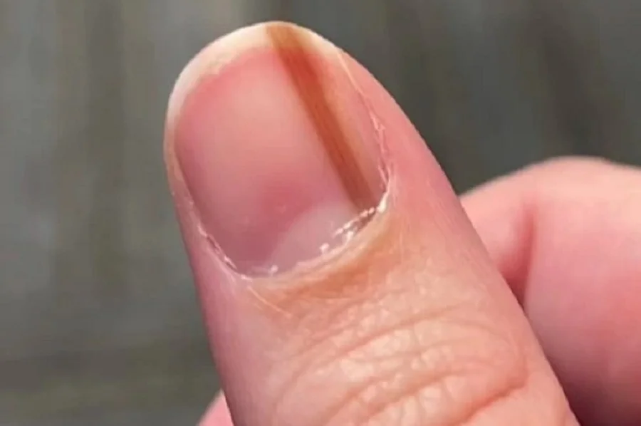 infecção na unha da mão