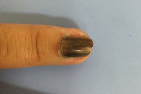 Manchas na Unha: Como Diferenciar Câncer, Micose e Hematoma