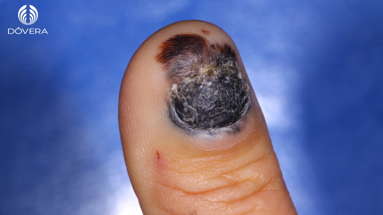 Melanoma Subungueal: O Que Você Precisa Saber Sobre o Câncer de Unha; Sinais de Alerta: Como Identificar o Câncer na Unha Precocemente; Carcinoma Espinocelular e Tumor Glômico: Outros Tipos de Câncer e Lesões na Unha; Diagnóstico e Fatores de Risco do Câncer de Unha: Um Guia Completo; Mancha Escura na Unha: Quando Procurar um Dermatologista?