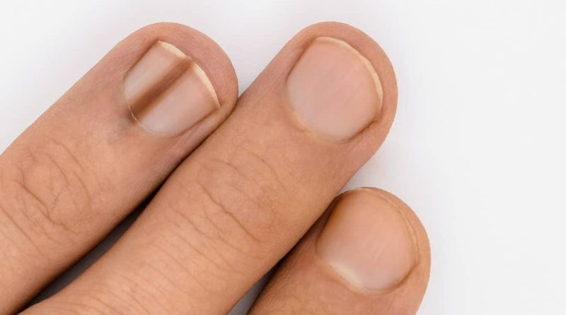 Melanoma Subungueal: O Que Você Precisa Saber Sobre o Câncer de Unha; Sinais de Alerta: Como Identificar o Câncer na Unha Precocemente; Carcinoma Espinocelular e Tumor Glômico: Outros Tipos de Câncer e Lesões na Unha; Diagnóstico e Fatores de Risco do Câncer de Unha: Um Guia Completo; Mancha Escura na Unha: Quando Procurar um Dermatologista?