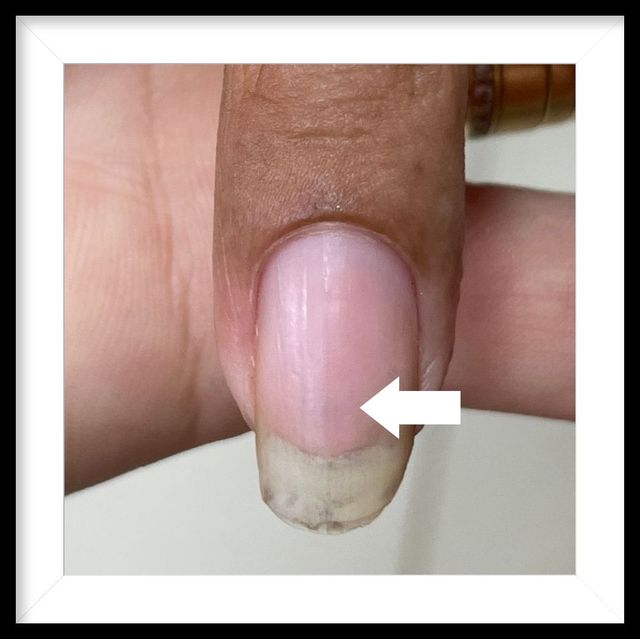 Melanoma Subungueal: O Que Você Precisa Saber Sobre o Câncer de Unha; Sinais de Alerta: Como Identificar o Câncer na Unha Precocemente; Carcinoma Espinocelular e Tumor Glômico: Outros Tipos de Câncer e Lesões na Unha; Diagnóstico e Fatores de Risco do Câncer de Unha: Um Guia Completo; Mancha Escura na Unha: Quando Procurar um Dermatologista?