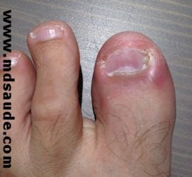 cefalexina serve para unha inflamada