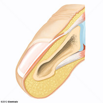 tratamento unha encravada