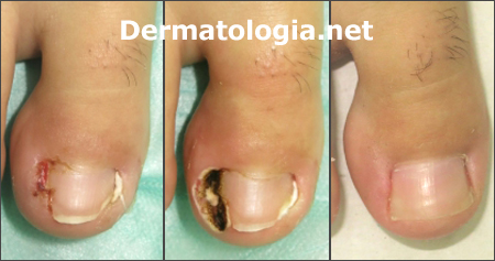 Onicocriptose: Causas