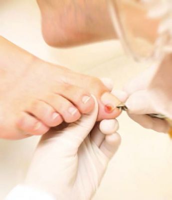 Como prevenir a unha encravada: Dicas essenciais