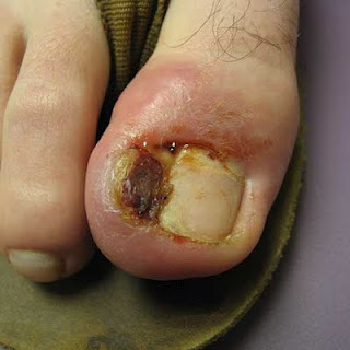 unha inflamada com calo