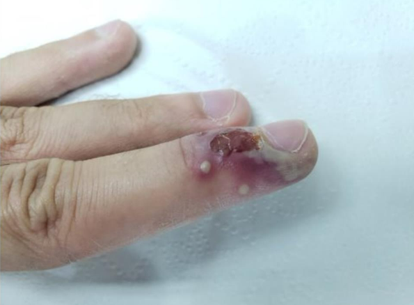 unha inflamada e infeccionada