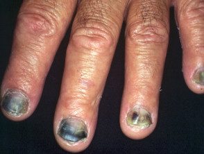 unha inflamada e roxa