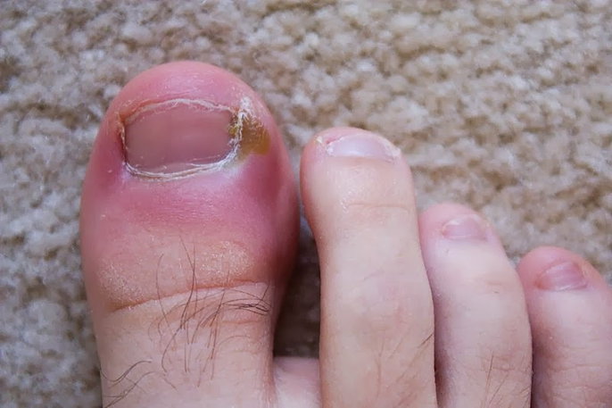 unha inflamada e com sangue