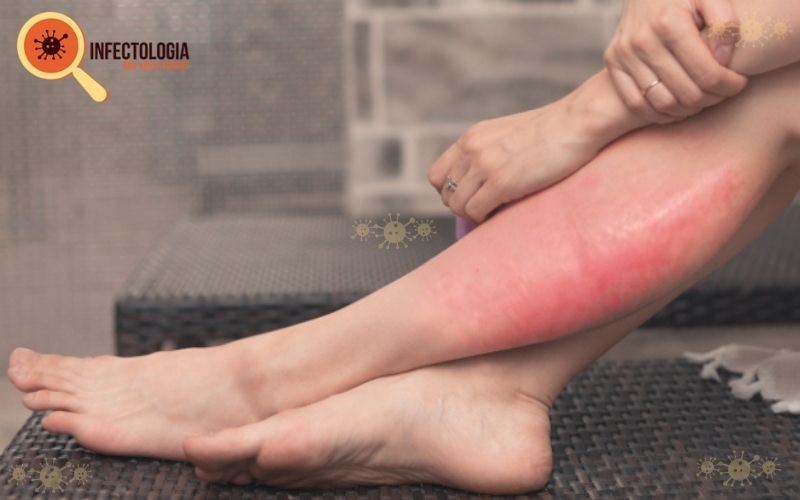 unha do pé inflamada