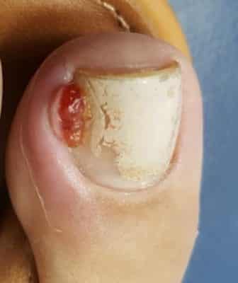 unha inflamada após corte