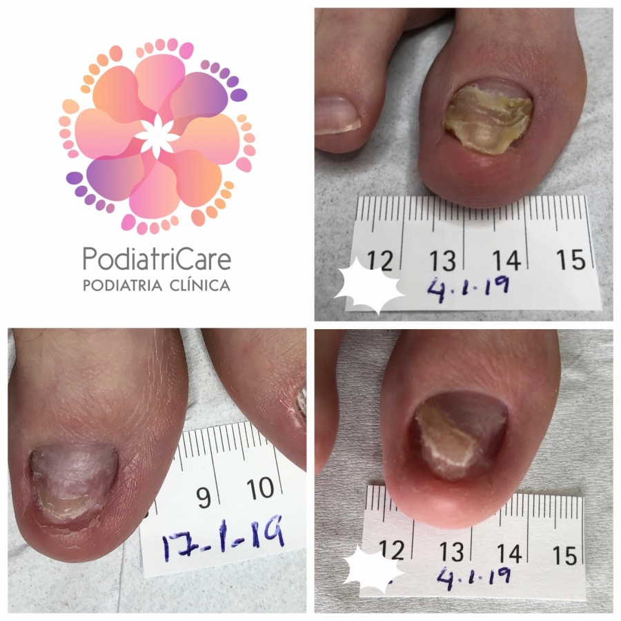 O Papel do Podólogo no Tratamento da Onicomicose: Quando Procurar Ajuda Profissional