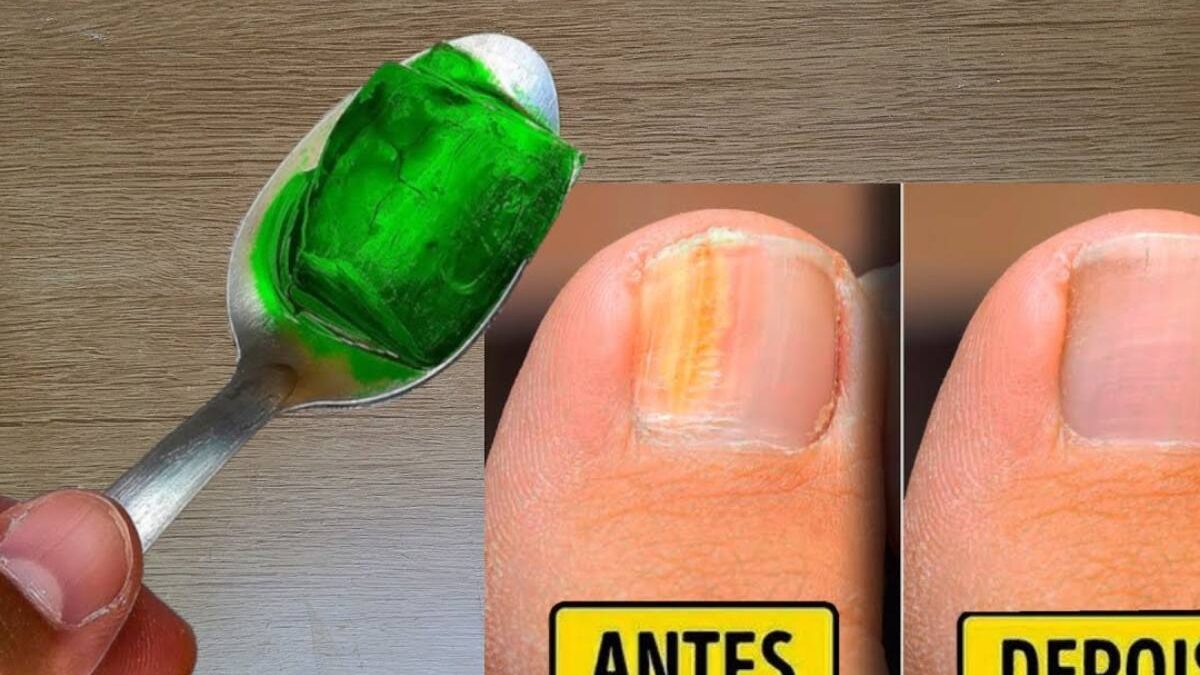 Esmaltes Antifúngicos vs. Remédios Orais: Qual a Melhor Opção para Sua Micose?