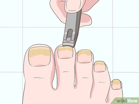 Esmaltes Antifúngicos vs. Remédios Orais: Qual a Melhor Opção para Sua Micose?