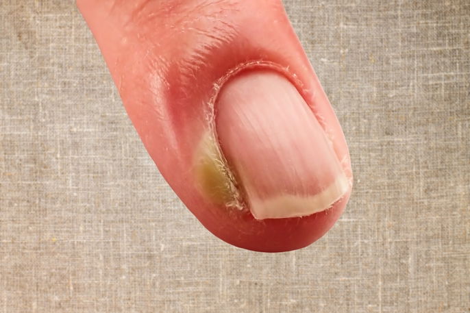 Sinais de Alerta: Quando a Unha Inflamada Indica Complicações Graves como Diabetes