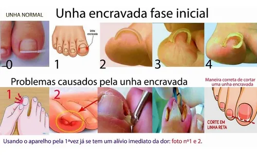 como desencravar unha