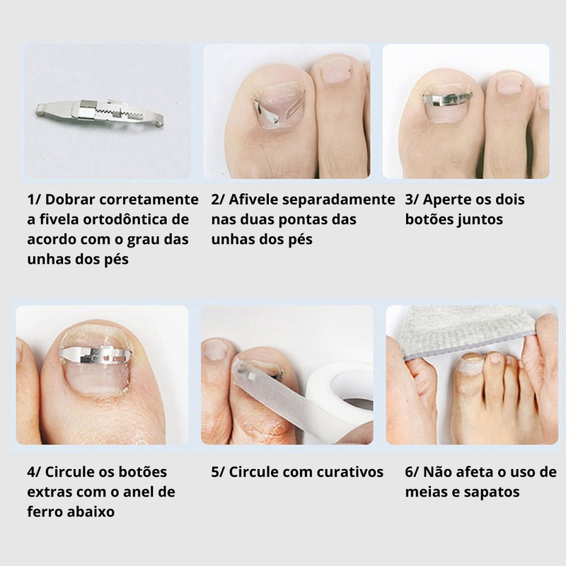 Guia completo: Como escolher o podólogo ideal para sua unha encravada