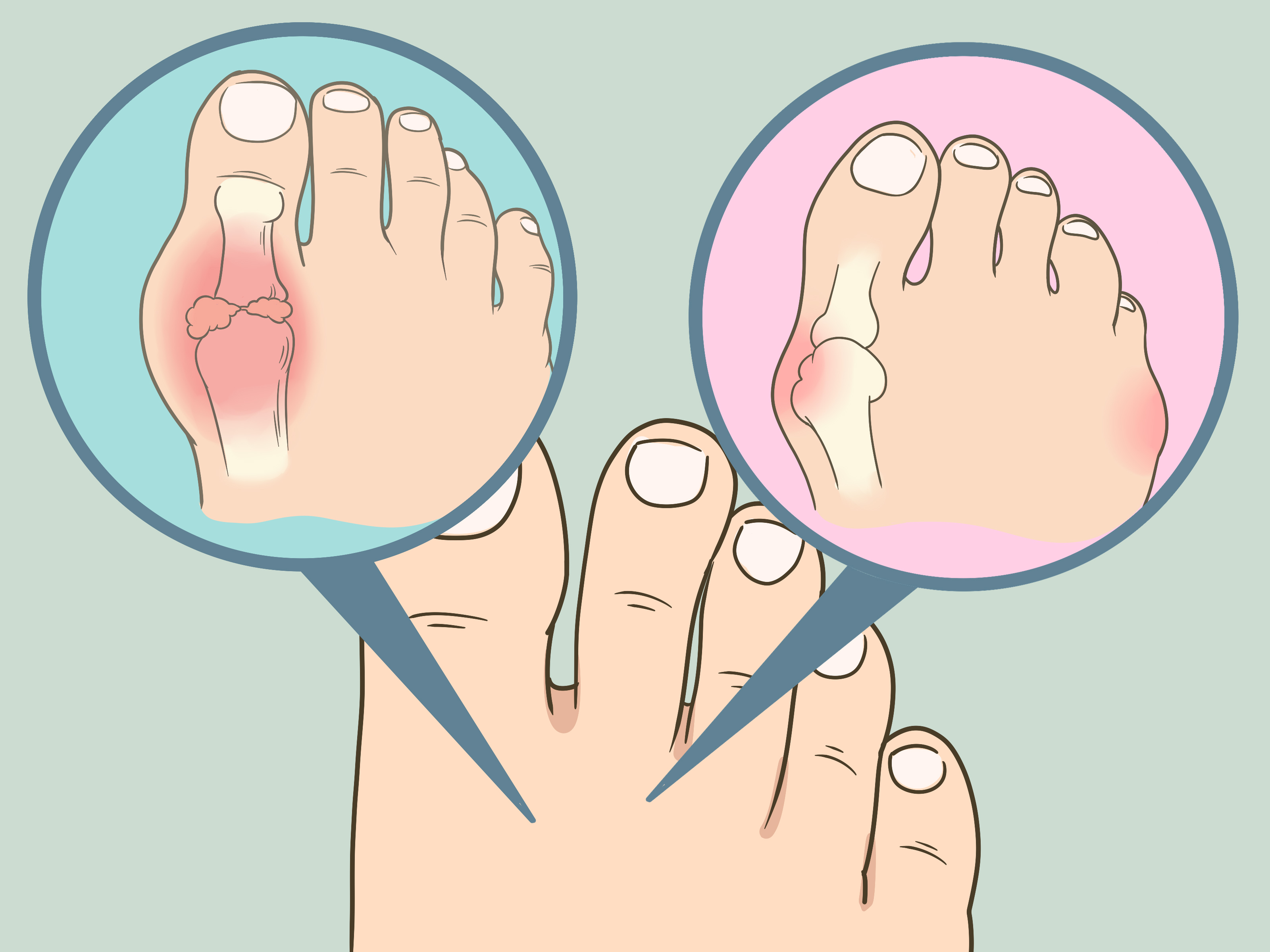 5 dicas para aliviar dor de unha encravada rápido