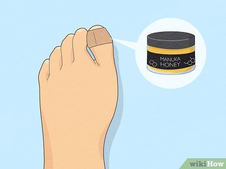 como desencravar unha em casa