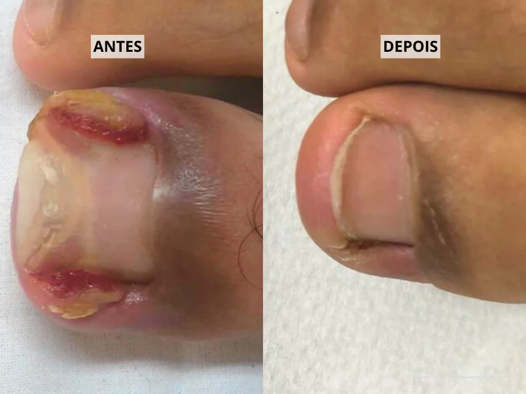 como deixar as unhas mais duras