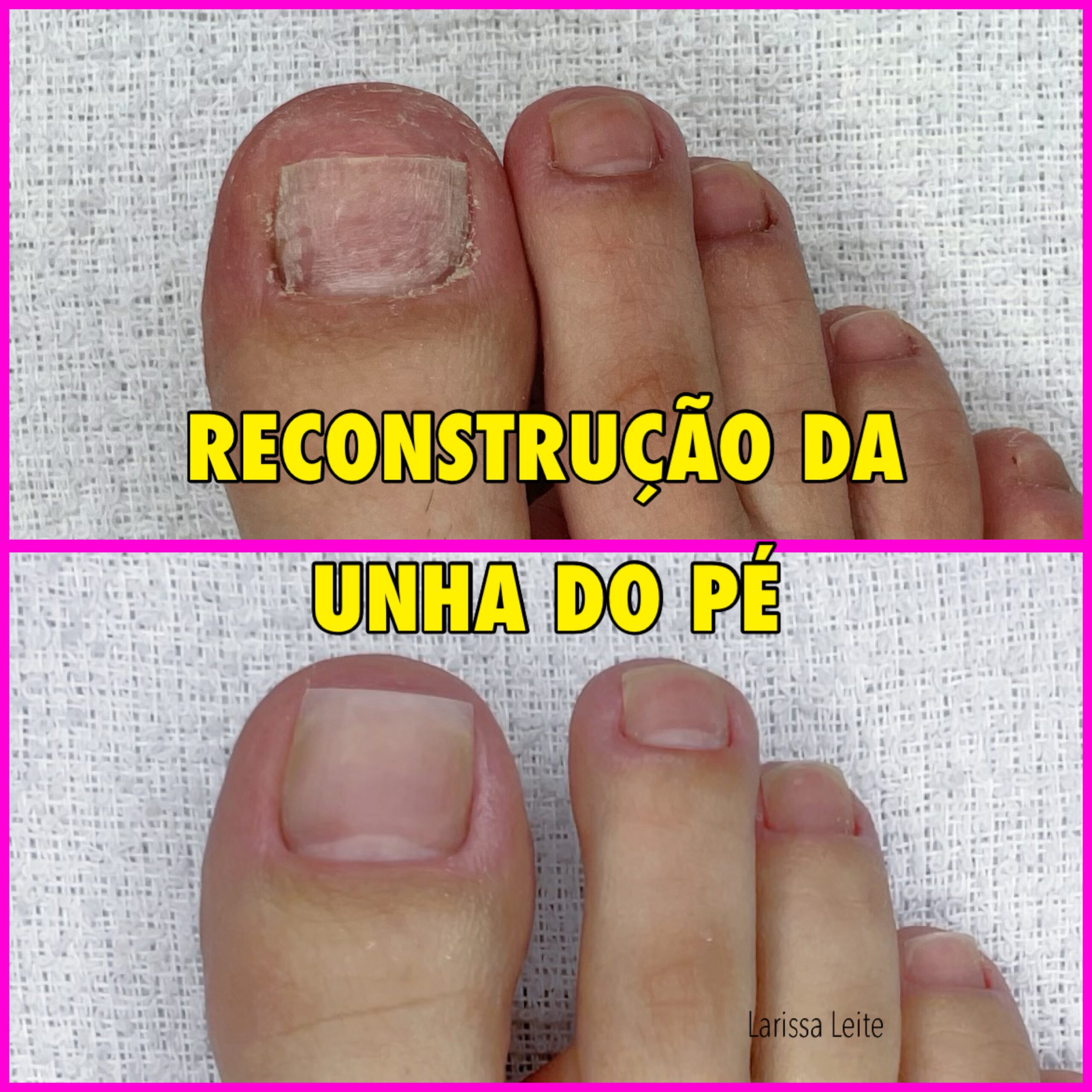técnica de remendo para unhas