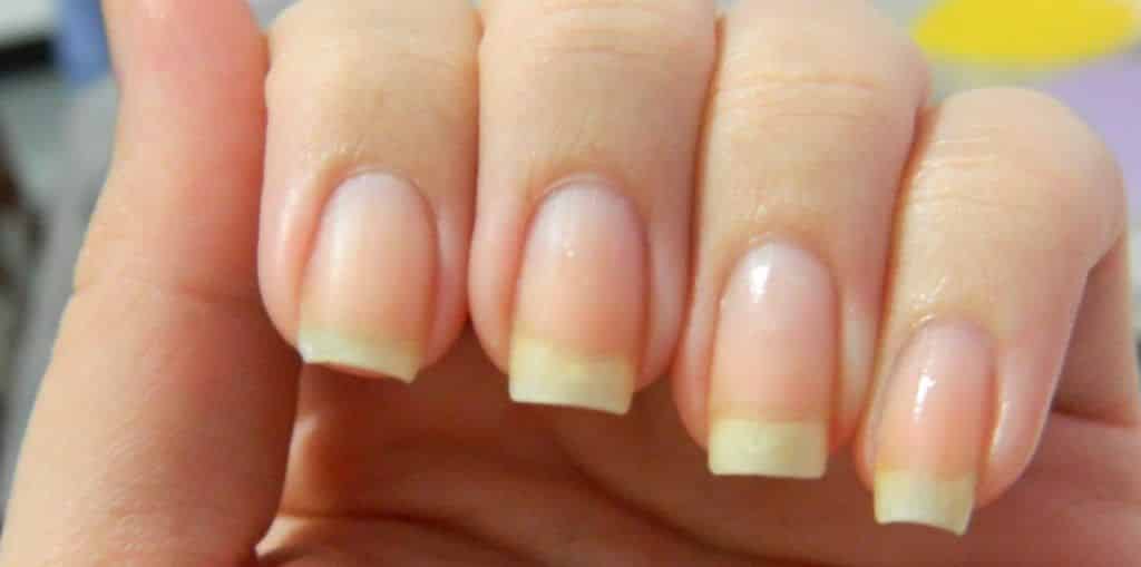 tratamento para unhas amareladas