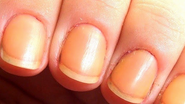 unhas amareladas causas