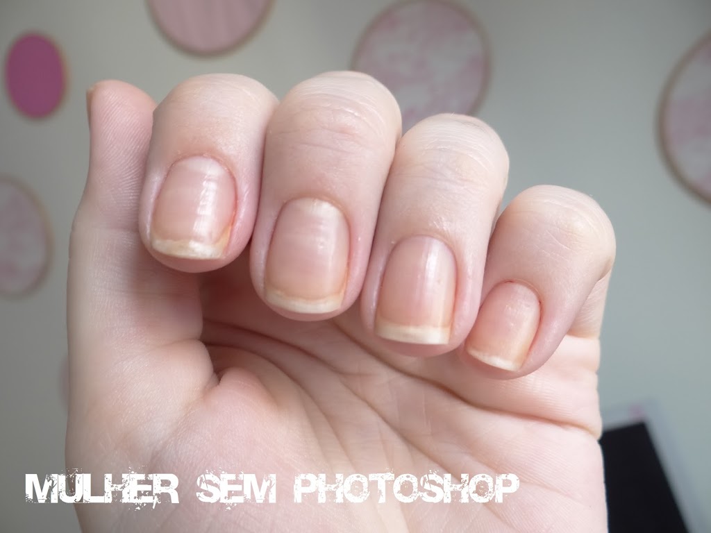unhas amareladas causas