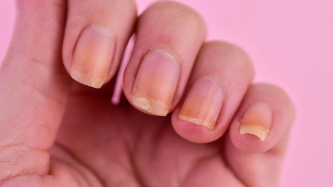 como tirar o amarelo da unha