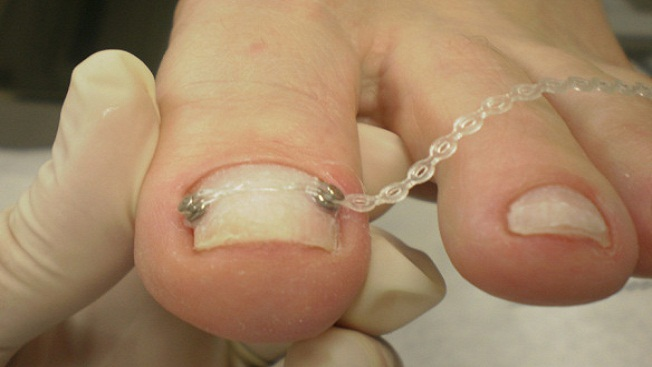 quanto custa tratar unha encravada