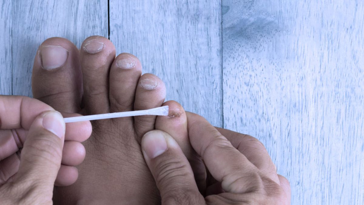 Terbinafina para Micose de Unha: Guia Completo de Uso