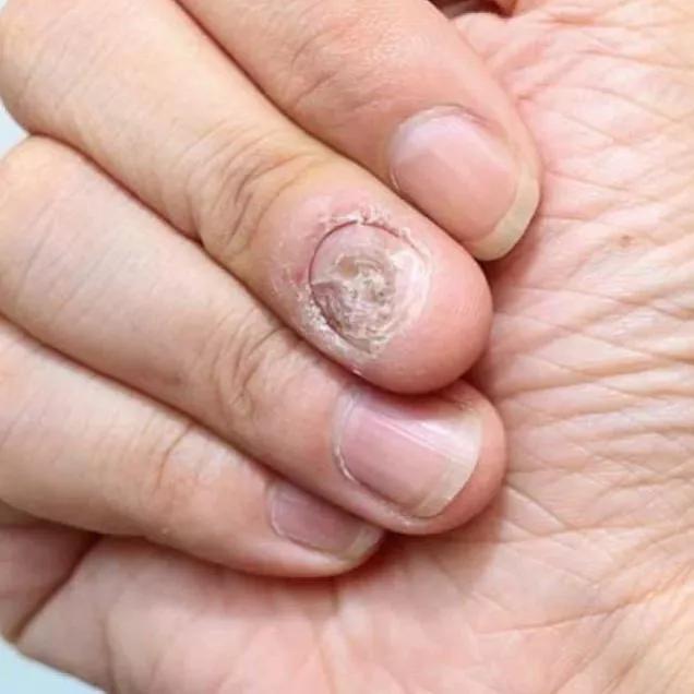 Os 5 Medicamentos Orais Mais Eficazes Contra Fungos nas Unhas