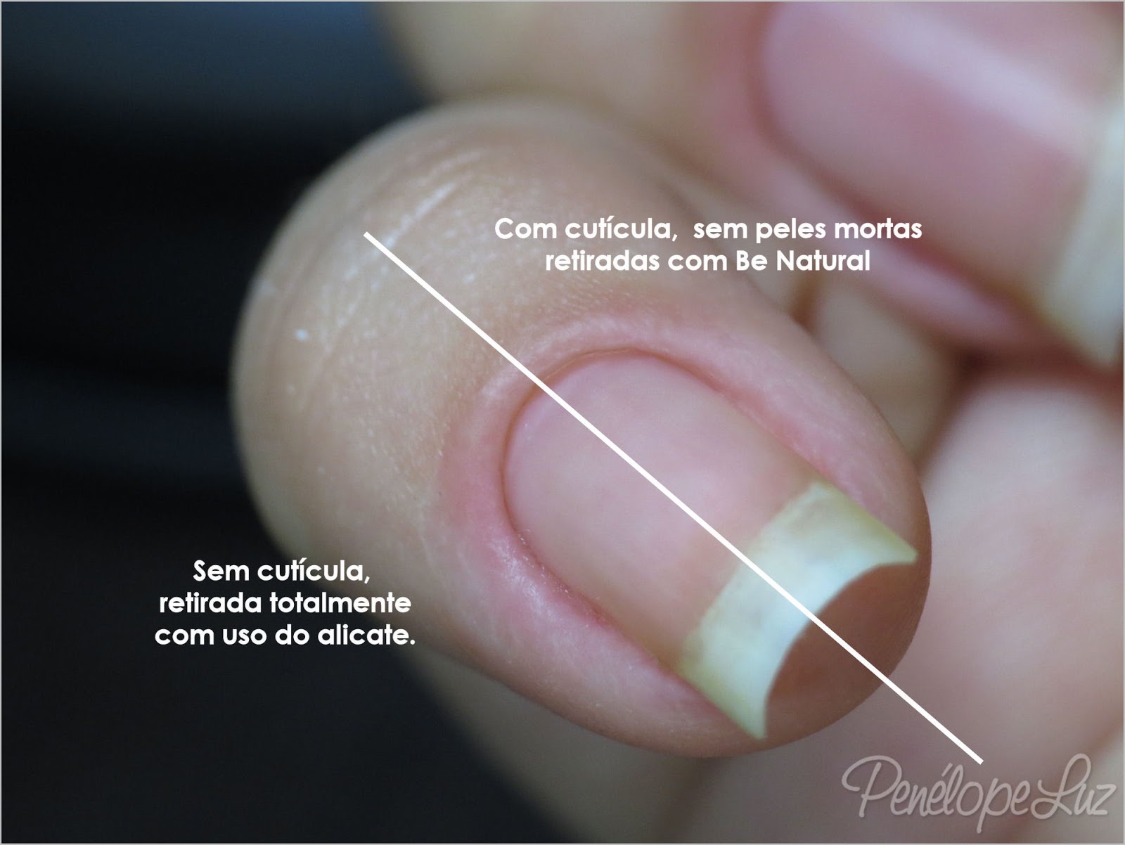riscos de tirar cuticula