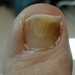 Dermatite em mãos e unhas