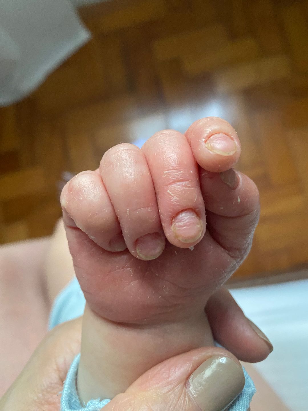 Dermatite atópica nas unhas