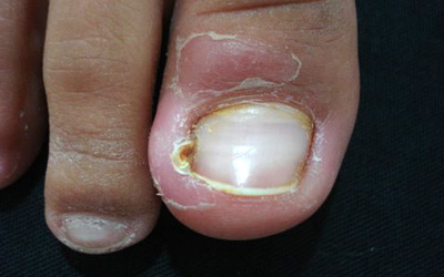 Dermatite de contato nas unhas