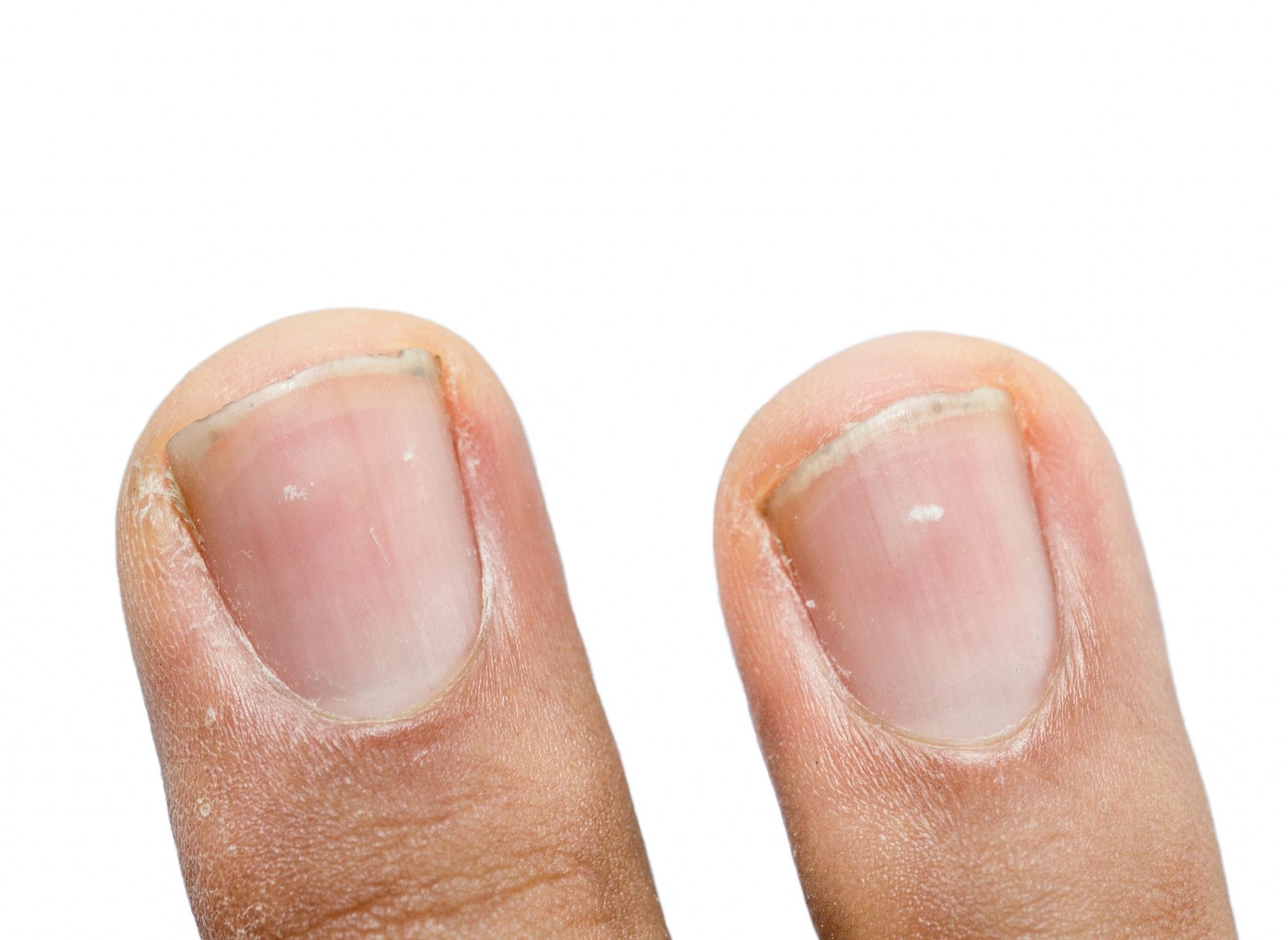 Unhas em gel e dermatite